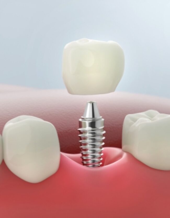 Single tooth implant