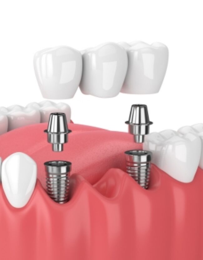 Multiple teeth implant