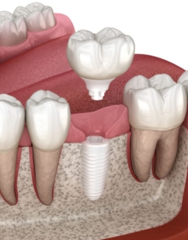 Metal-Free Dental Implants