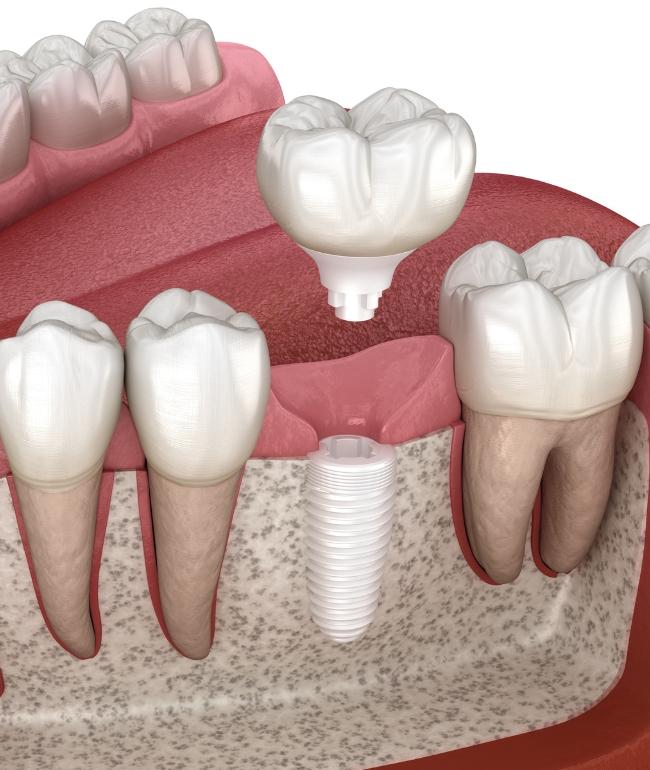 Metal-Free Dental Implants