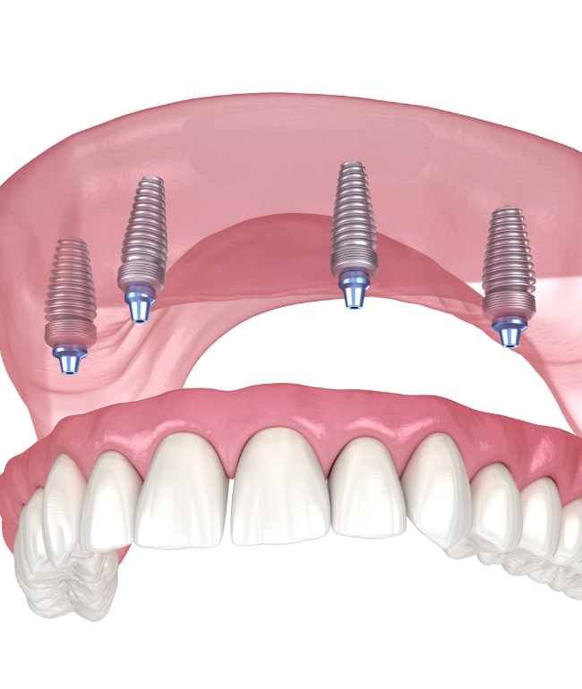 Full arch implants