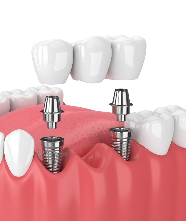 Multiple teeth implant