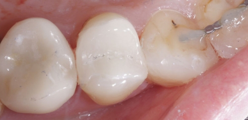 Aesthetic restoration after