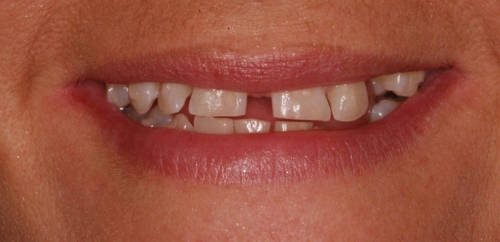 Smiledesign with Orthodontics before