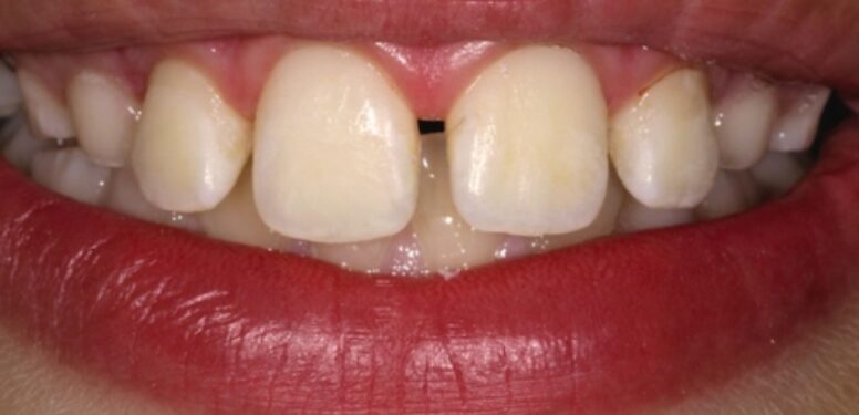 Icon remineralisation before