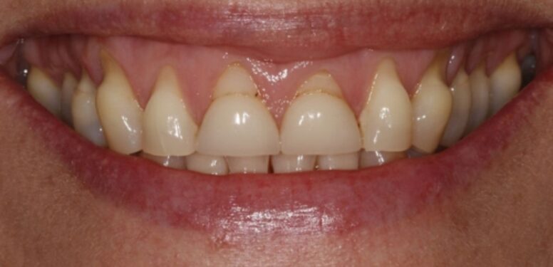 Smiledesign with Veneers before