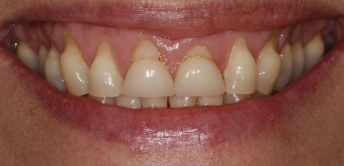 Smiledesign with Veneers before