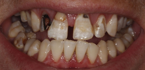 Smile Rehabilitation before