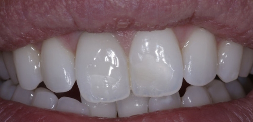 Teeth Whitening after