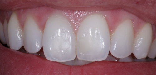 Teeth Whitening before