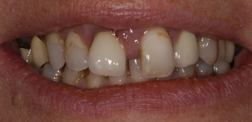 Smiledesign with Veneers and Crowns before