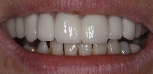 Smiledesign with Veneers and Crowns after