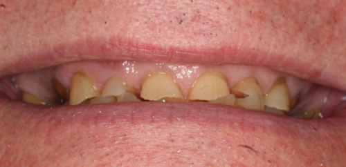 Full Mouth Rehabilitation before