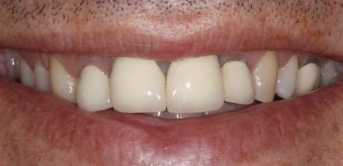 Mini Smiledesign before