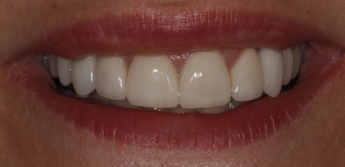 Smiledesign with Implants after