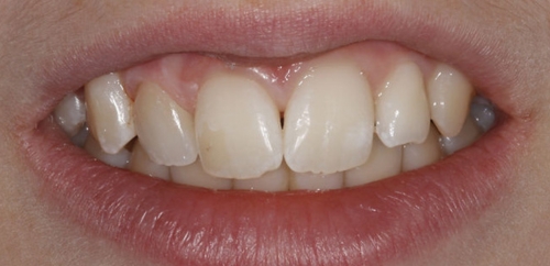 Single Tooth Veneer on Upper Right Lateral Tooth after
